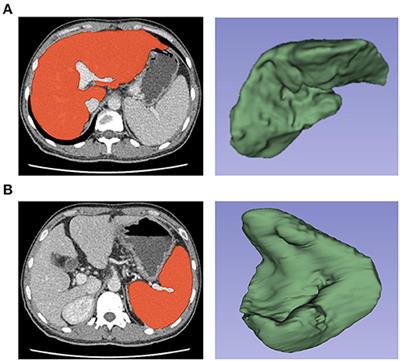CT-Based Radiomics Score Can Accurately Predict Esophageal Variceal Rebleeding in Cirrhotic Patients